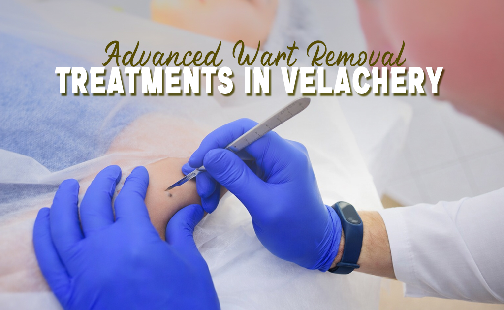 Laser wart removal in Velachery for painless and effective skin treatment