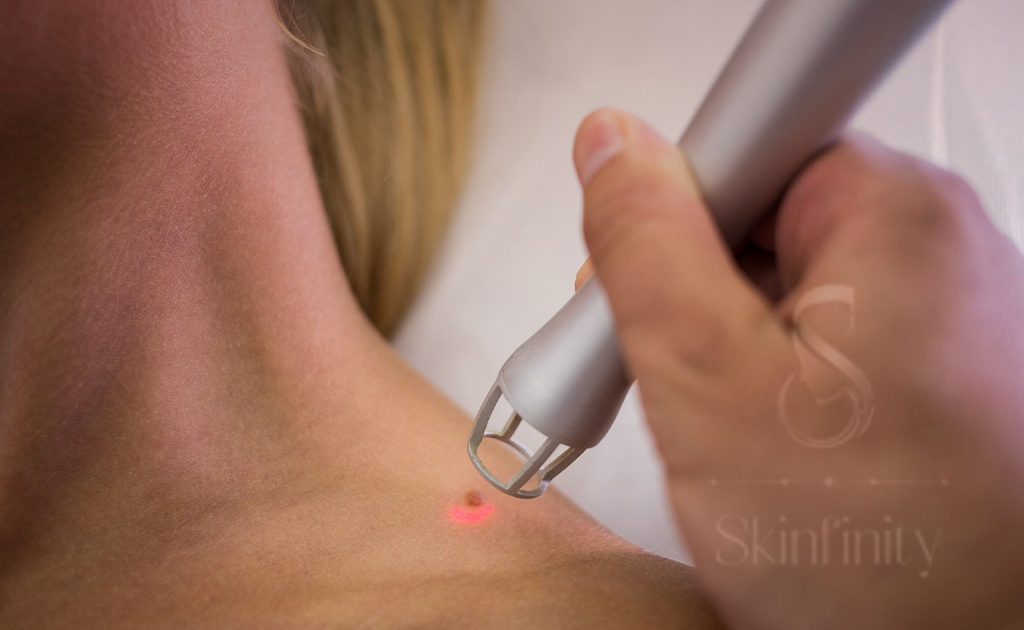 Wart Removal in Velachery using advanced surgical procedure by dermatologist