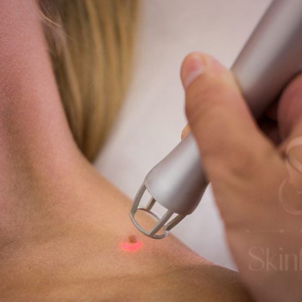 Wart Removal in Velachery using advanced surgical procedure by dermatologist